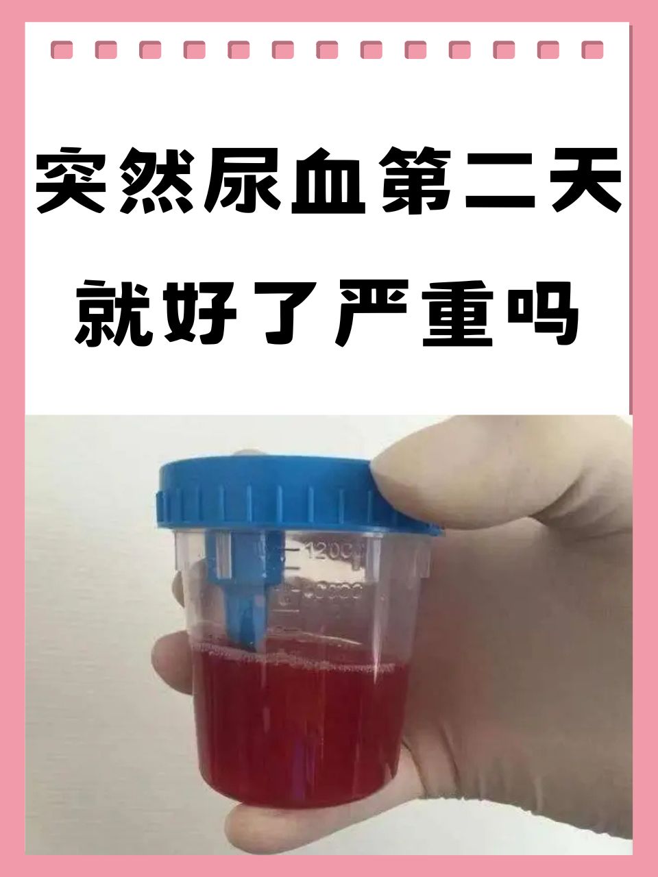 尿潜血2十是怎么回事图片