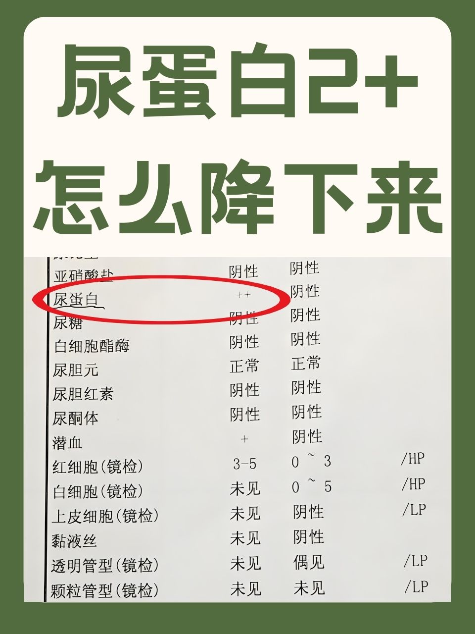 在尿常规检查中,尿蛋白2 是一个常见的异常指标
