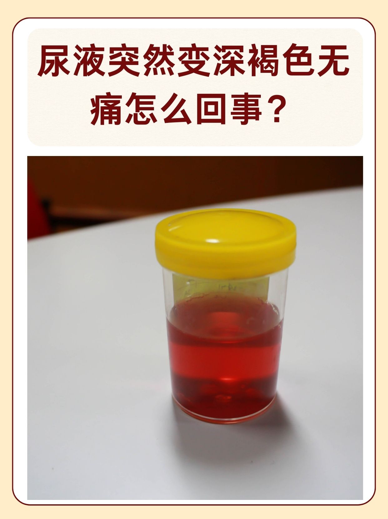 那么,尿液突然变深褐色无痛是怎么回事呢?下面我们一起来了解一下