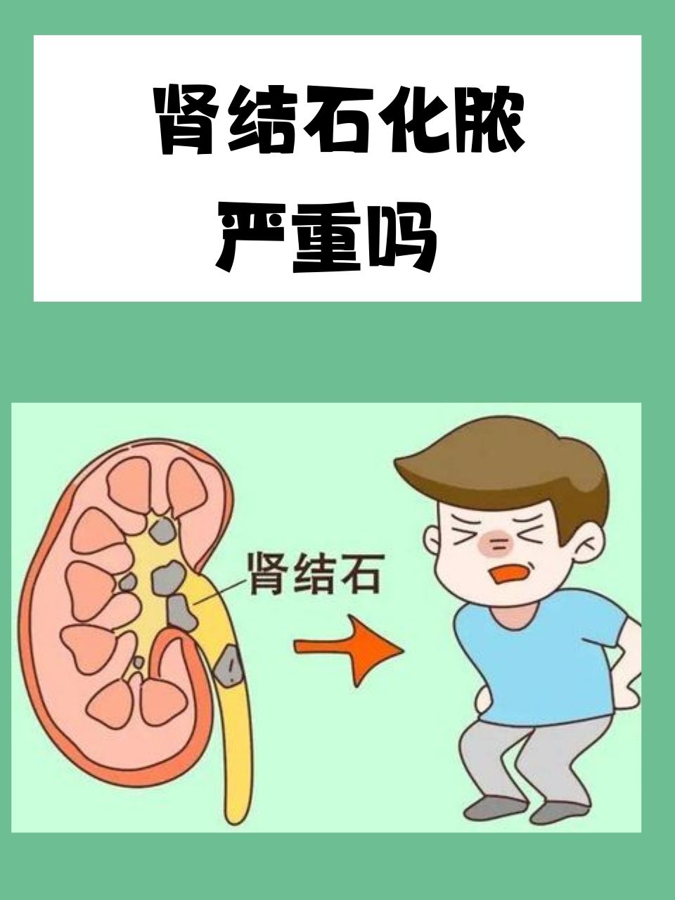 肾结石,这一常见的泌尿系统疾病,如果不及时治疗