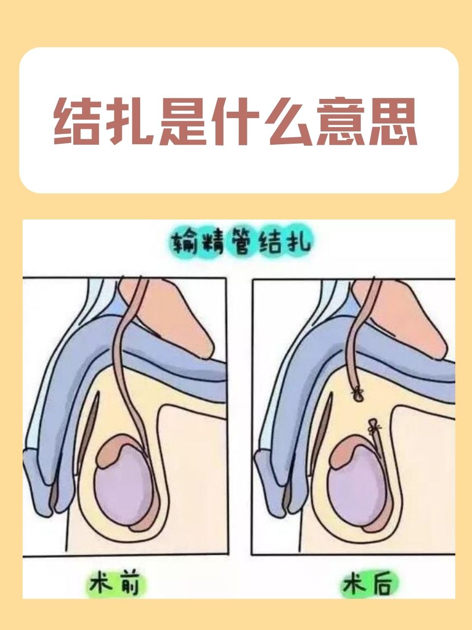 避孕方式多种多样,而结扎作为一种