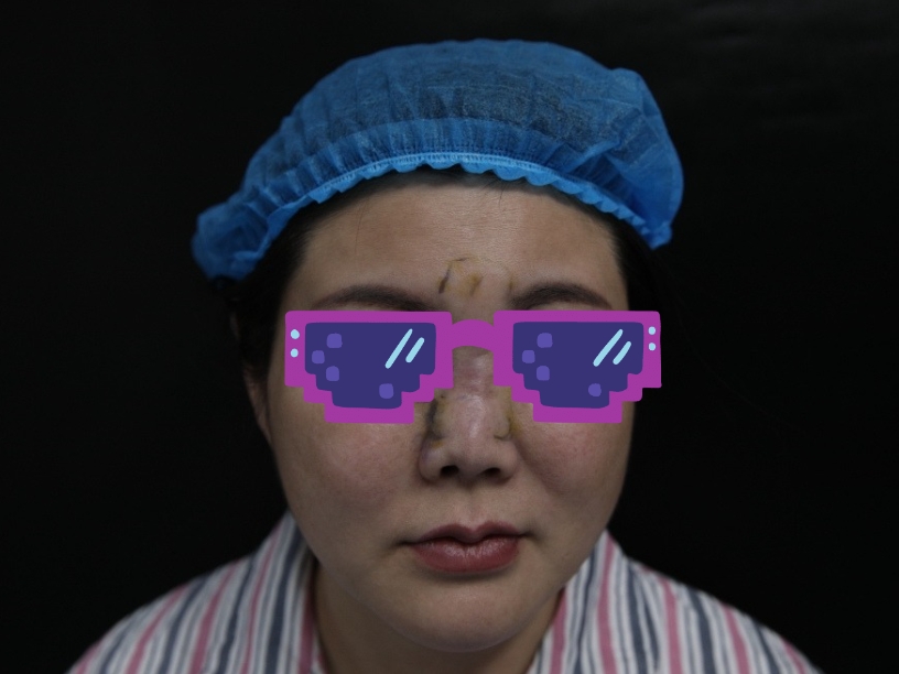 45岁女士打爱贝芙隆鼻,排异后变得像阿凡达