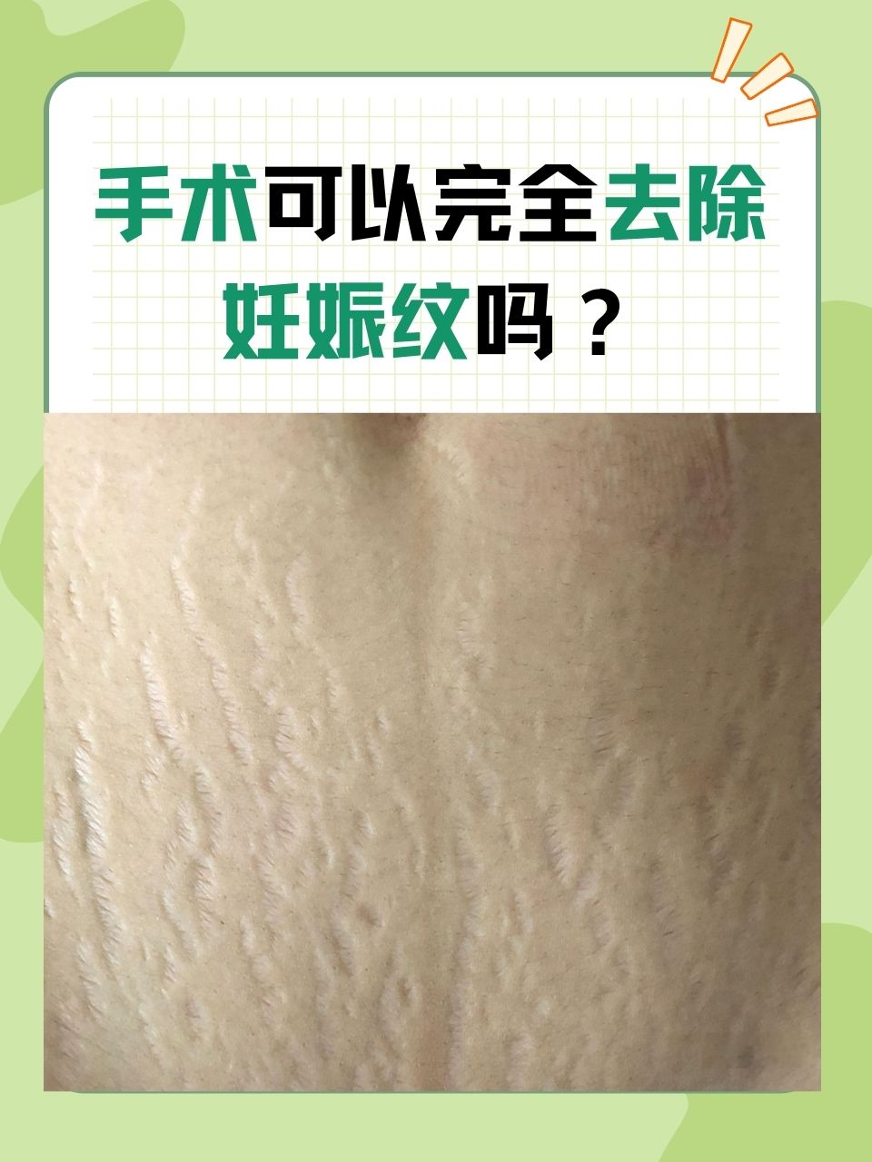 手术可以完全去除妊娠纹吗  随着小生命的降临,许多新妈妈也会面临一