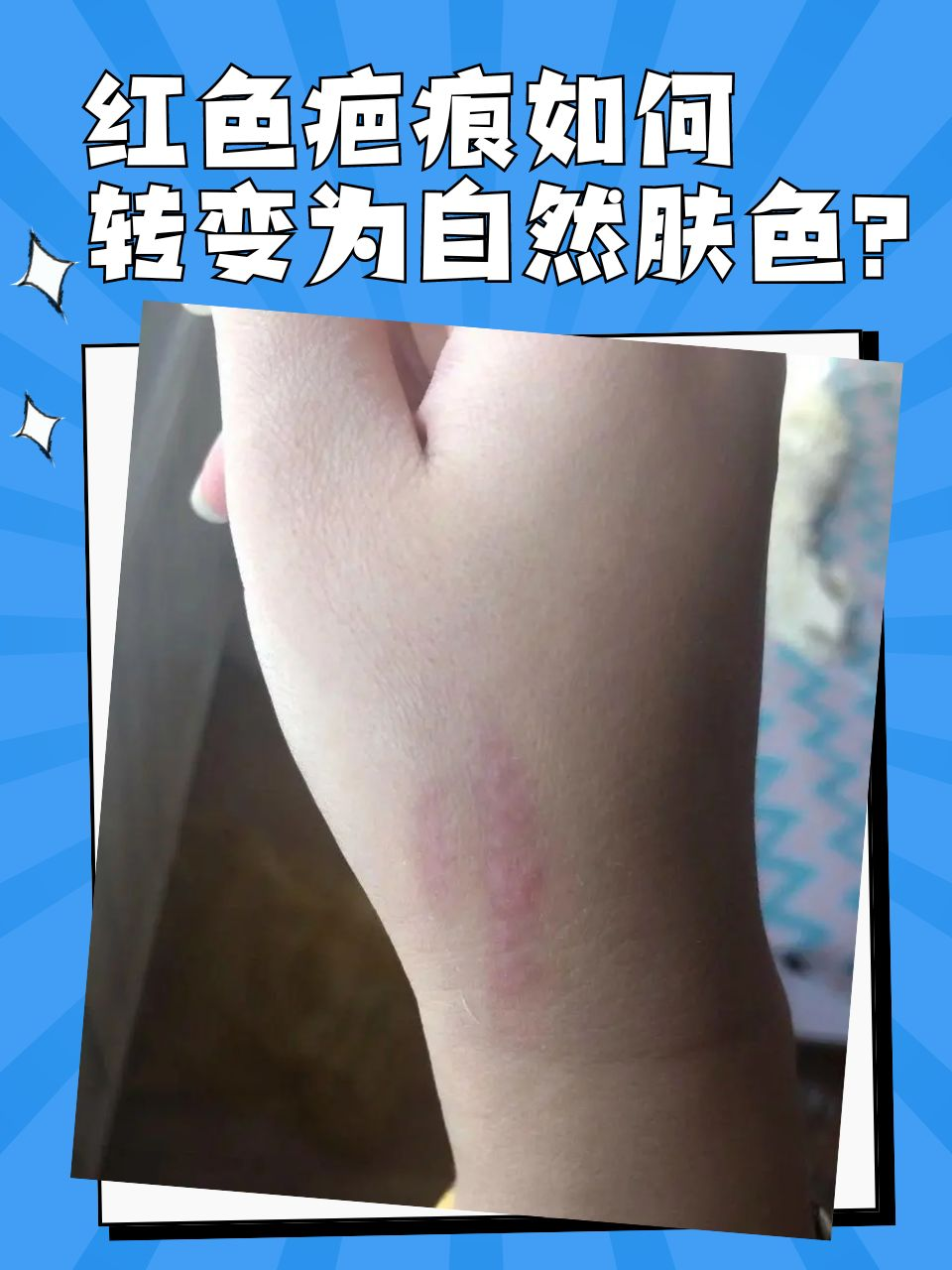 红色疤痕,如同肌肤上的一抹瑕疵,令人烦恼.