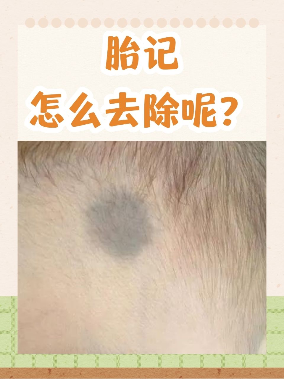 胎记位置