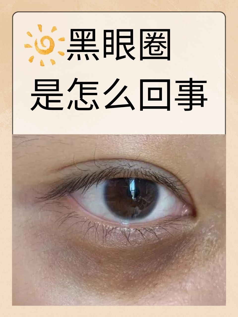 睡眠很好为什么还有黑眼圈 睡眠很好为什么还有黑眼圈