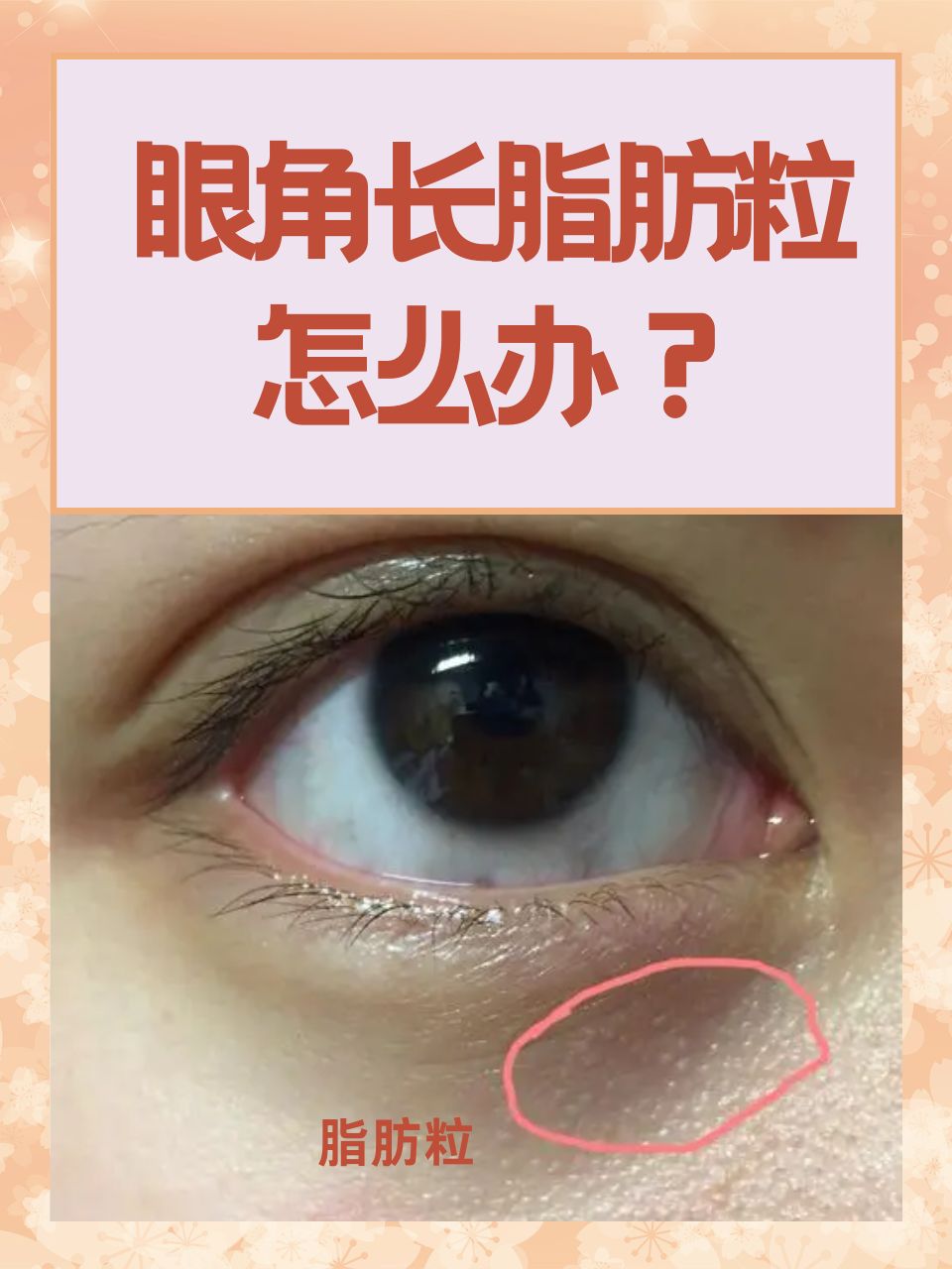 眼角长脂肪粒怎么办?