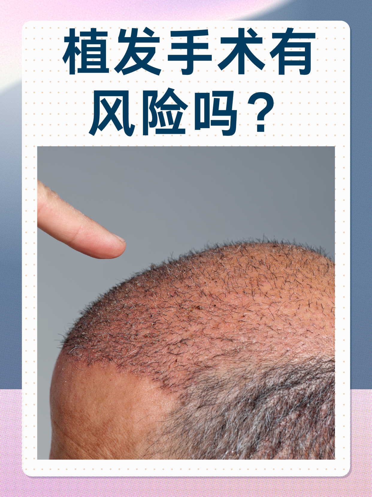 植发技术 与风险 为何不建相关图片2