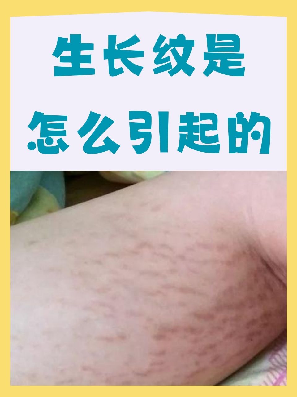 那么,生长纹究竟是怎么引起的呢?