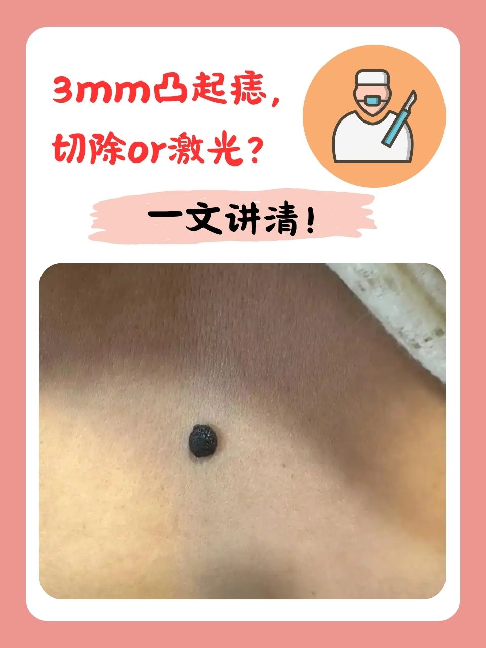 切除还是激光? 凸起的痣相较