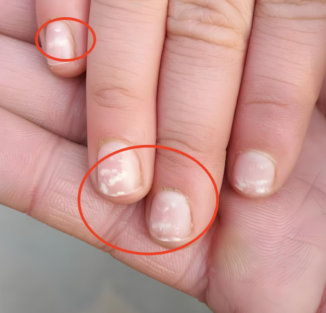 其实这种现象在医学上称为"点状白甲",多数和这几种情况有关