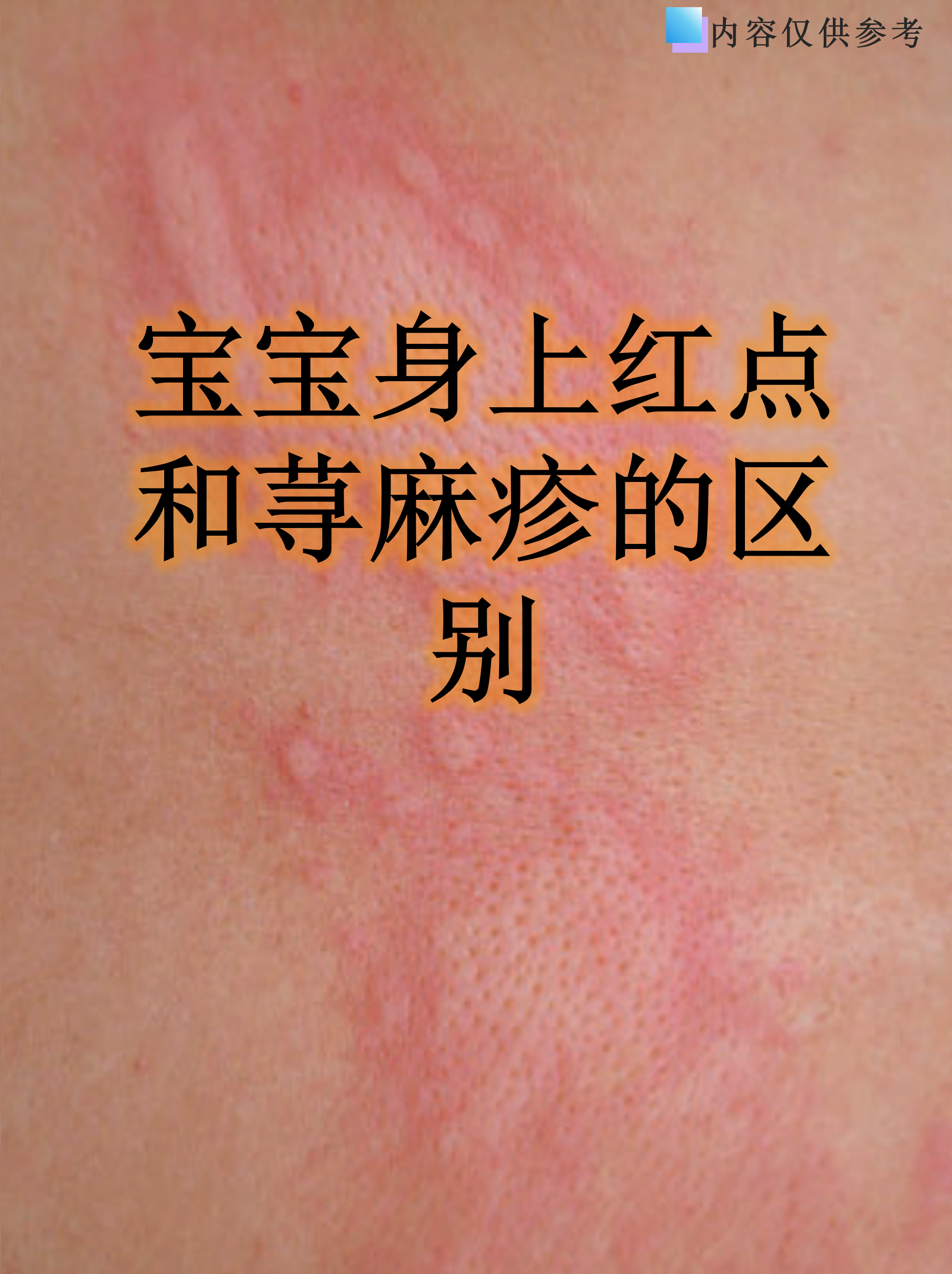 宝宝身上红点和荨麻疹的区别
