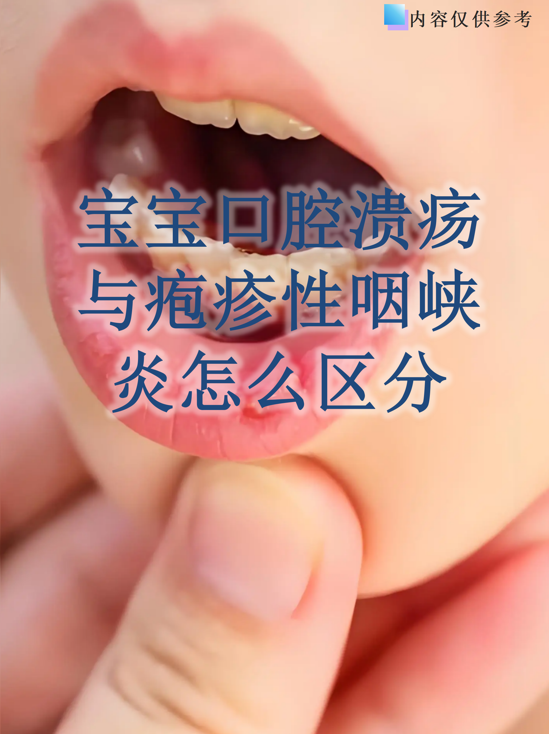 宝宝口腔溃疡与疱疹性咽峡炎怎么区分