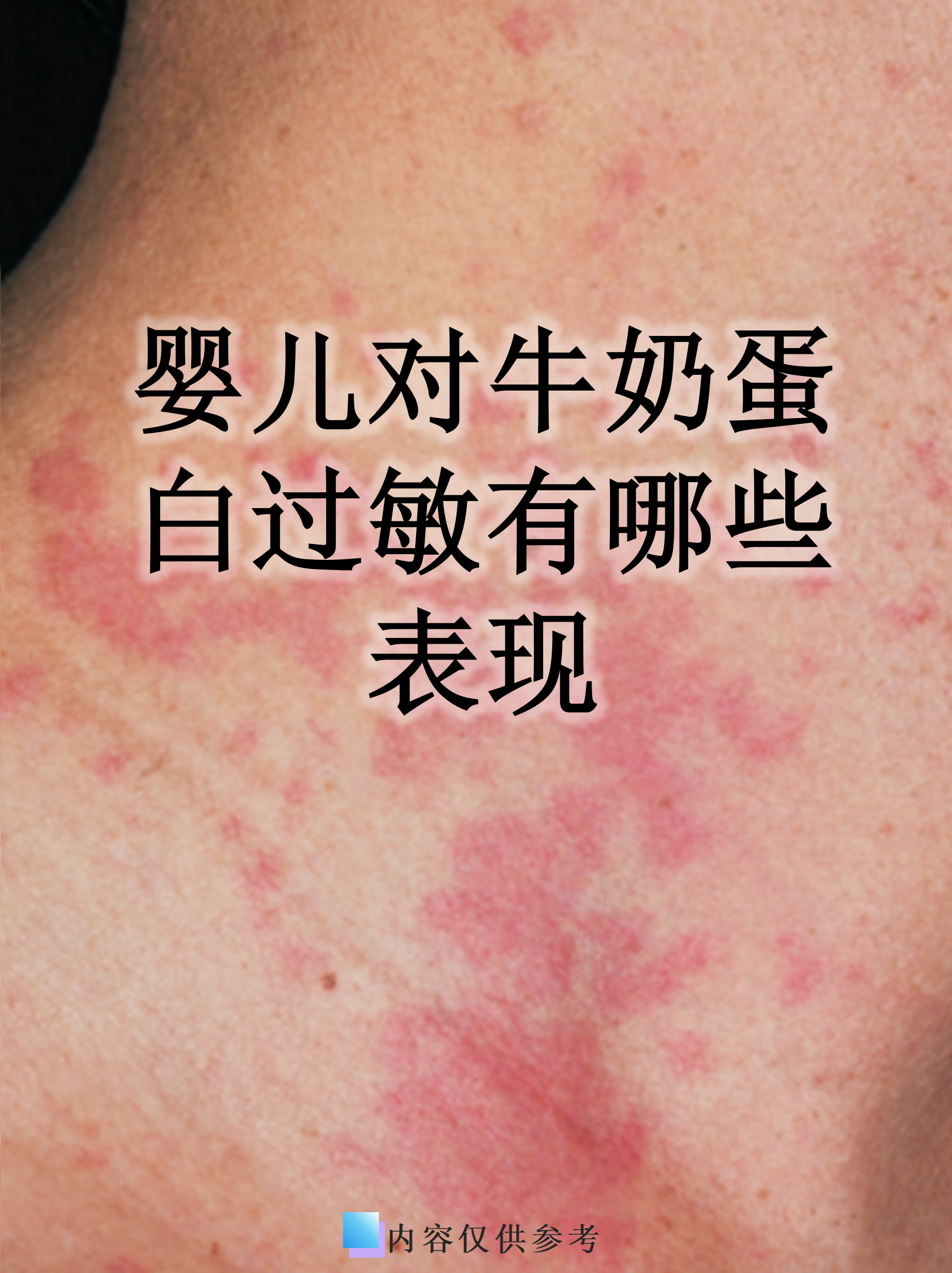 婴儿对牛奶蛋白过敏有哪些表现