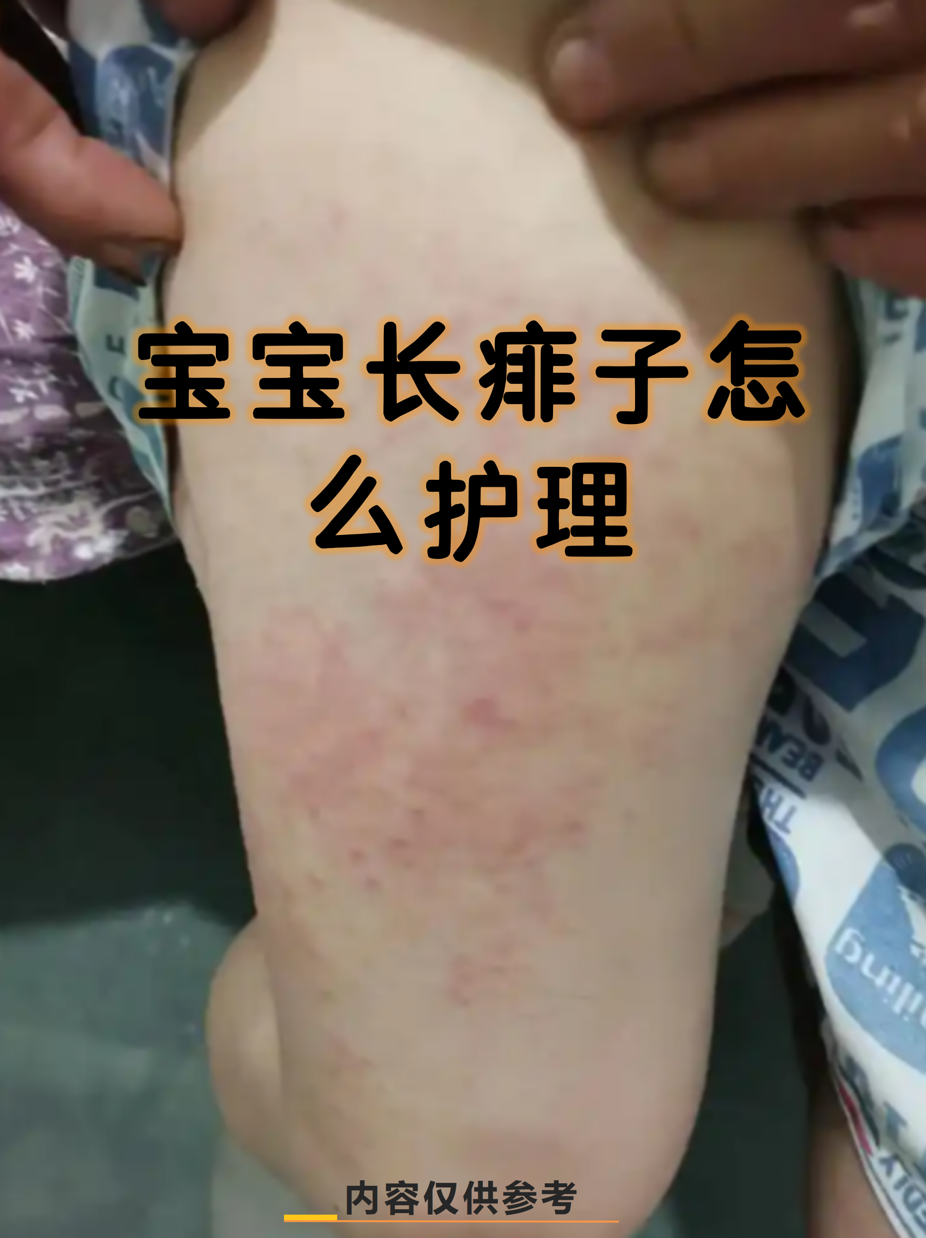 痱子虽然不严重,但护理不当可能引发瘙痒甚至感染,掌握科学方法才能让