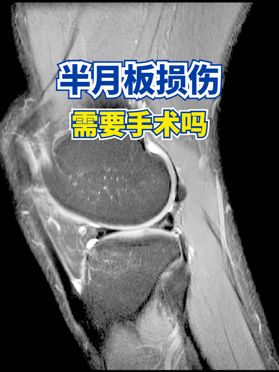 半月板损伤需要手术吗