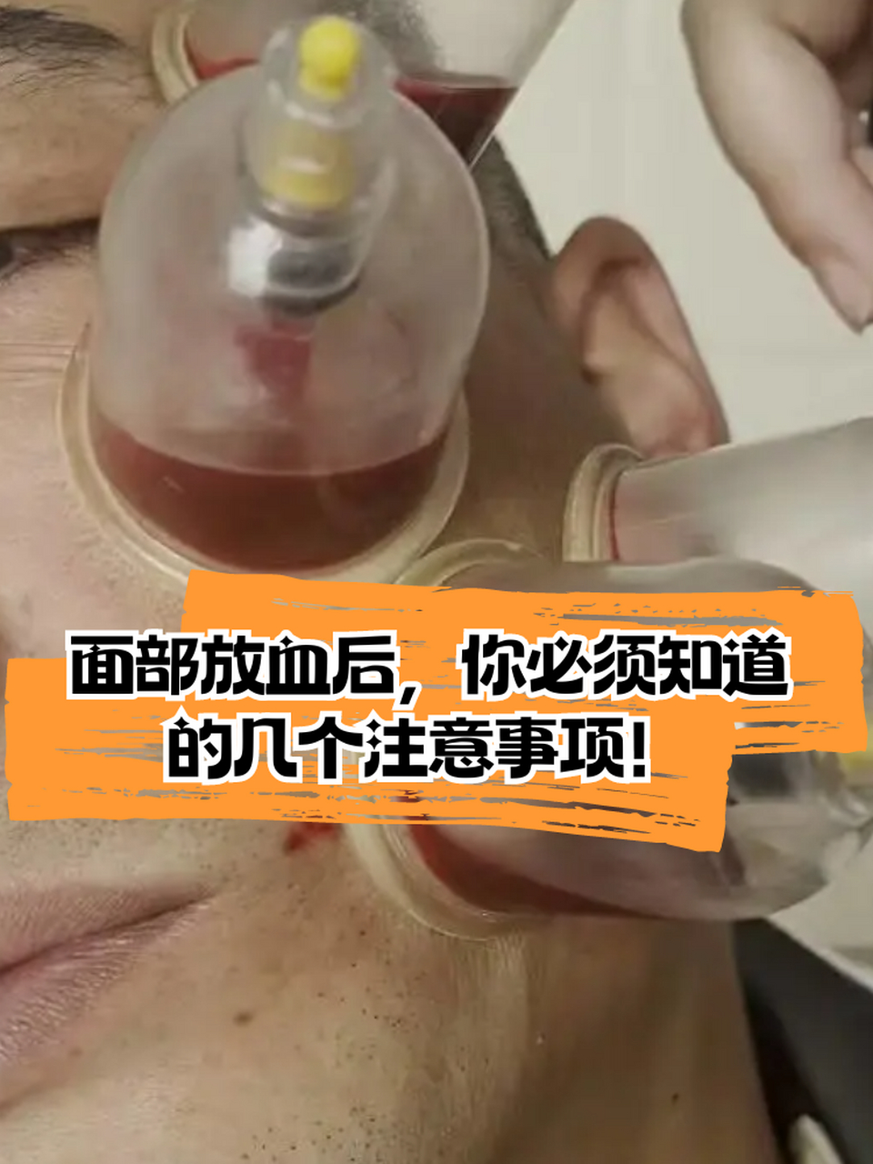 但大家注意,面部放血后有几点需要注意:  🙋局部卫生要注意  放血后