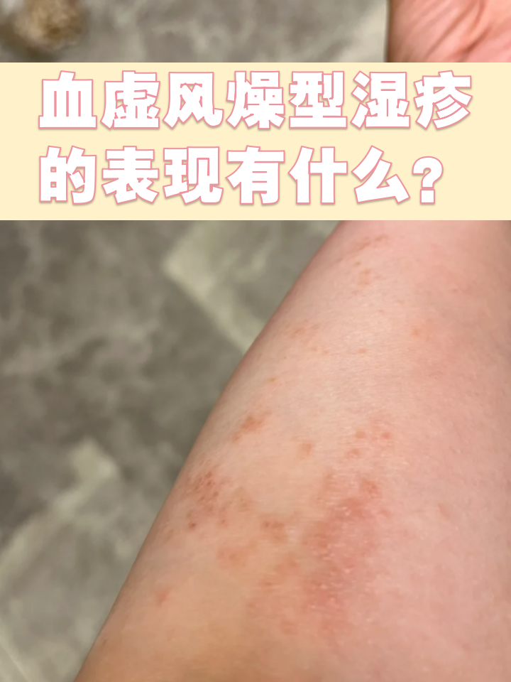 血虚风燥型湿疹的表现有什么?