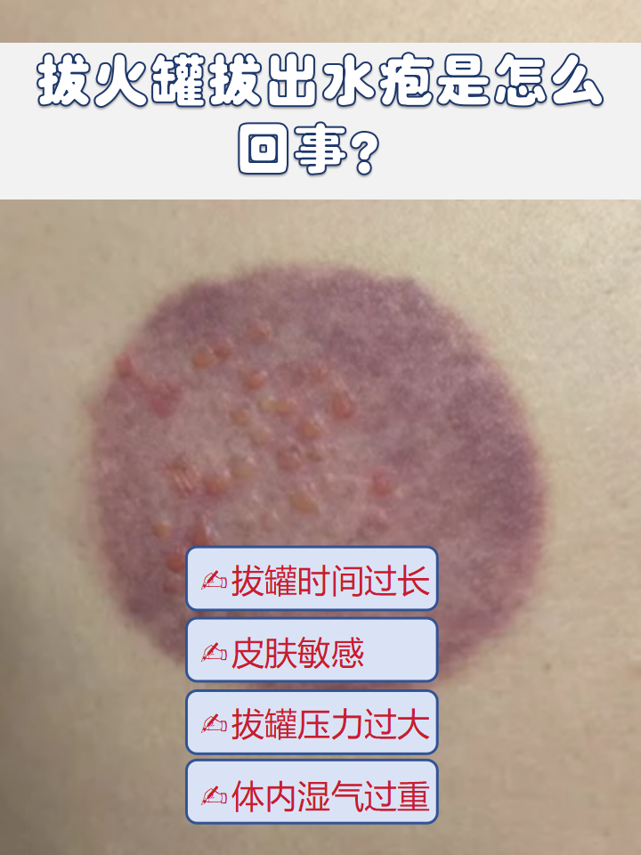 拔火罐是一种传统的中医疗法,但有时拔火罐后会出现水泡,这是蚀么