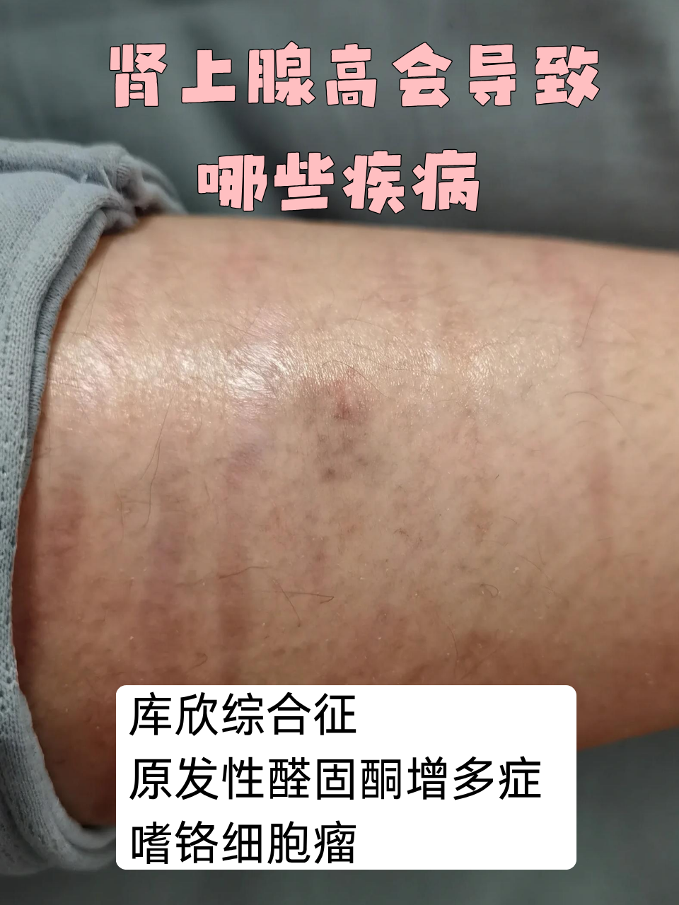 肾上腺高会导致哪些疾病