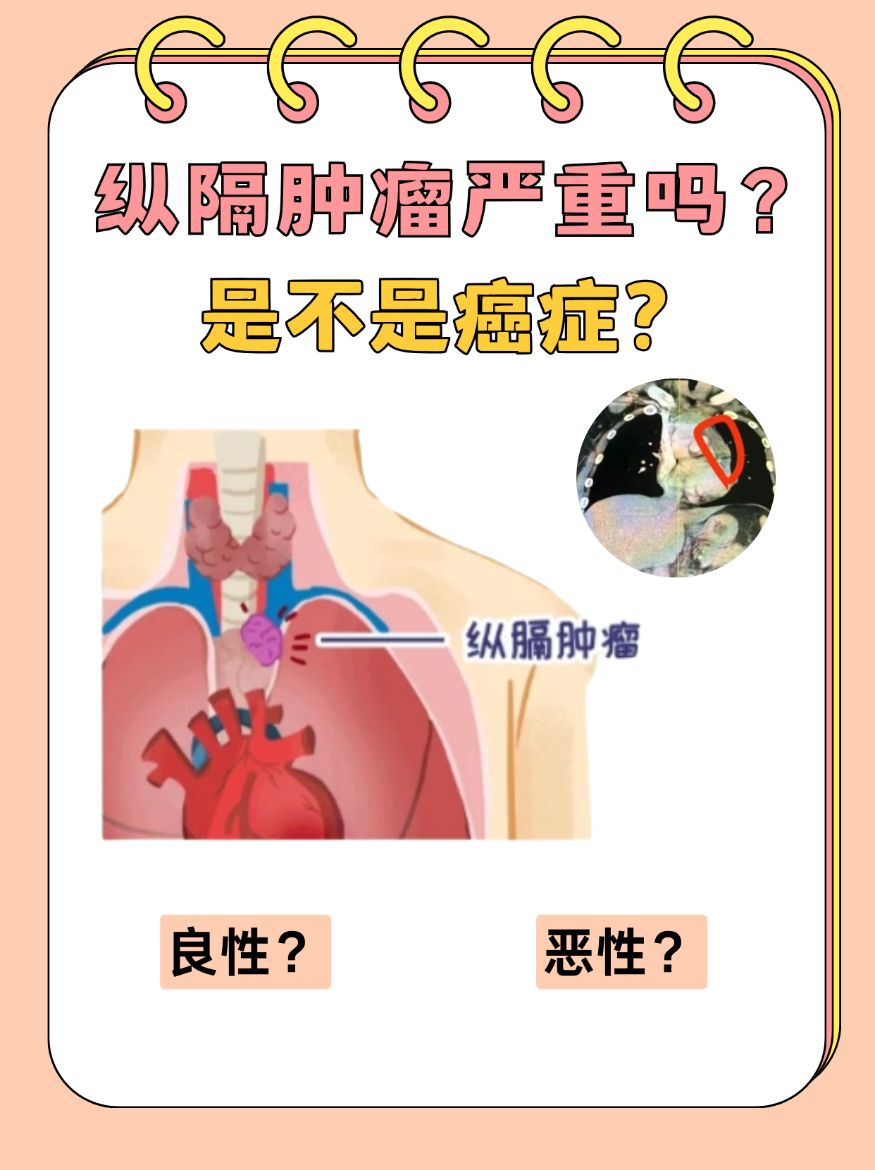 纵隔肿瘤是否严重