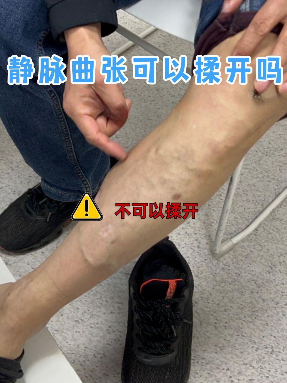 快来一探究竟 静脉曲张已成为一种常见的健康问题,尤其困扰着长时间