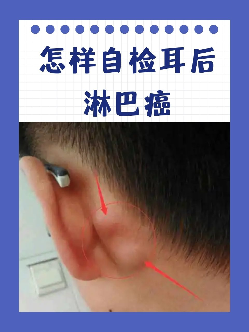 怎样自检耳后淋巴癌 在探讨健康问题的众多话题中,耳后淋巴癌这一名称