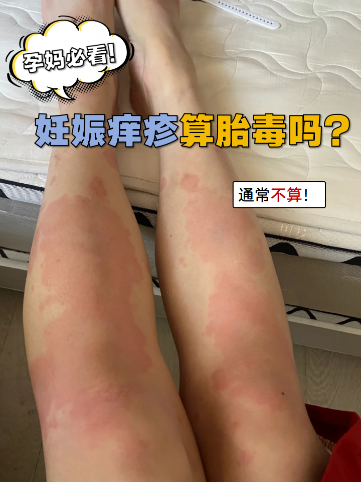 妊娠痒疹算胎毒吗?