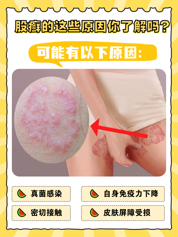 股癣,一个让不少人头疼的皮肤问题,它悄无声息地侵袭着我们的私密