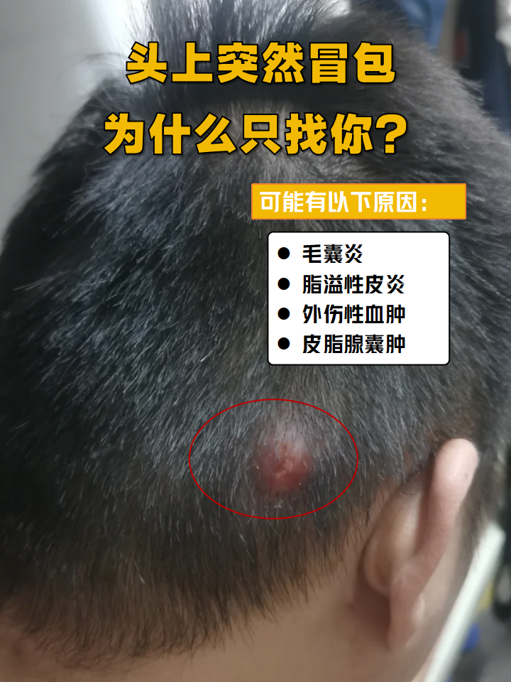 头上突然冒包,可能有以下原因 毛囊炎:头皮油脂分泌旺盛,堵塞毛矿后