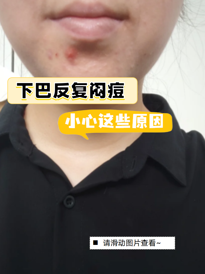 下巴为什么起痘