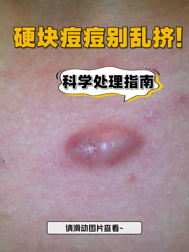 怎么消除脸上长痘痘红肿硬块摸起来很疼结节痤疮图片结节痘痘怎么消除