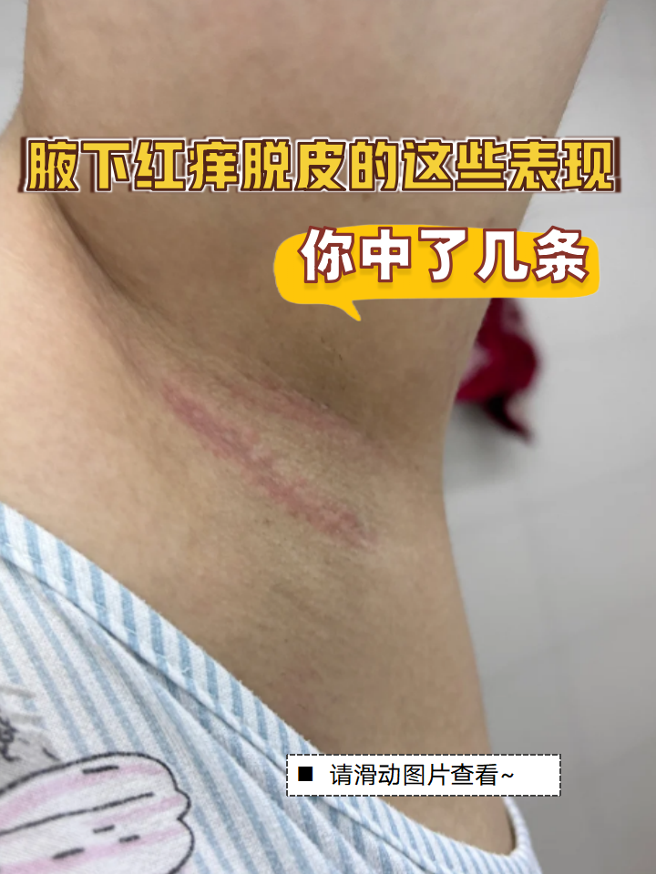 别担心,今天从皮肤科角度为你解析腋下皮肤问题的成因,并提供安全有效