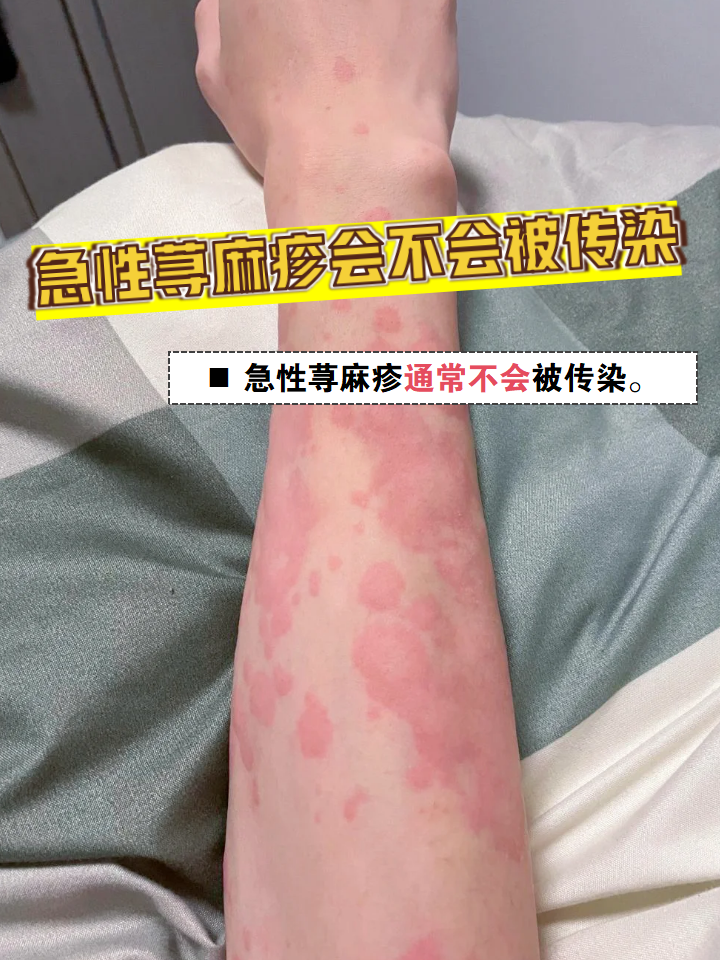 急性荨麻疹会不会被传染