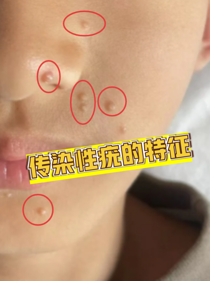 簇集分布 白色角逐嗍鞘裁囱油计羽嗍鞘裁囱油计 儿童初期小疣