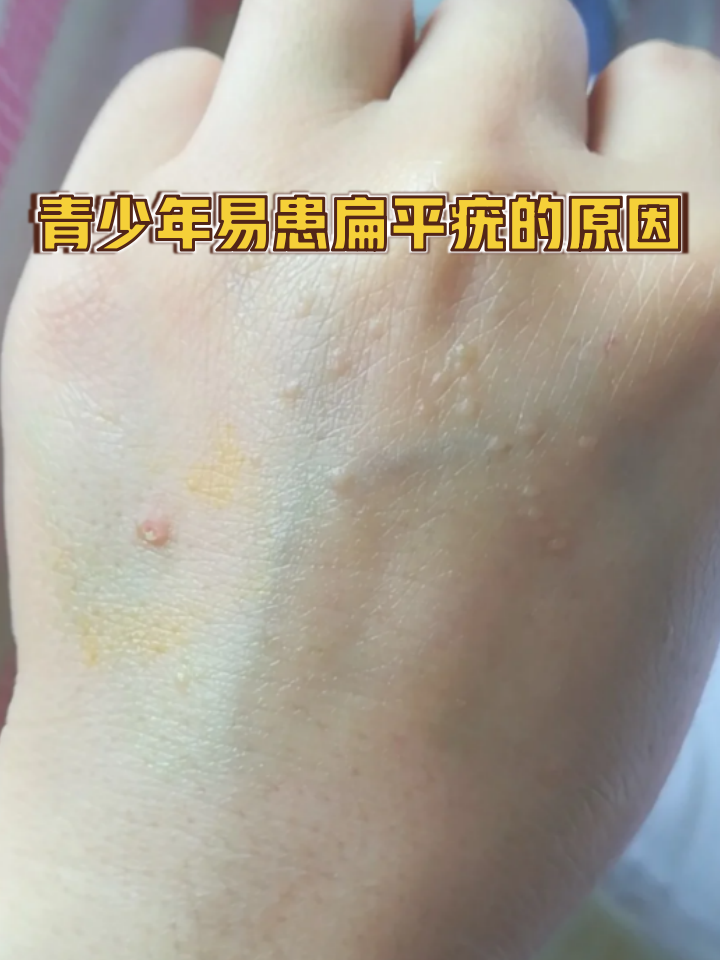 这很可能是扁平疣在作祟!为何青少年特别容易中招?