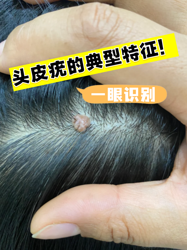 别急着抠!可能是头皮疣在悄悄生长
