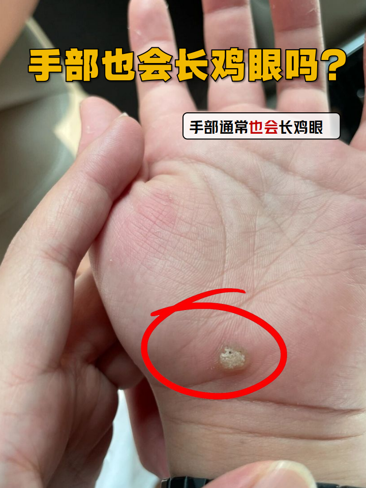 长期玩手机,写字,做手工的你,是否发现手指突然长出硬硬的小疙? ?