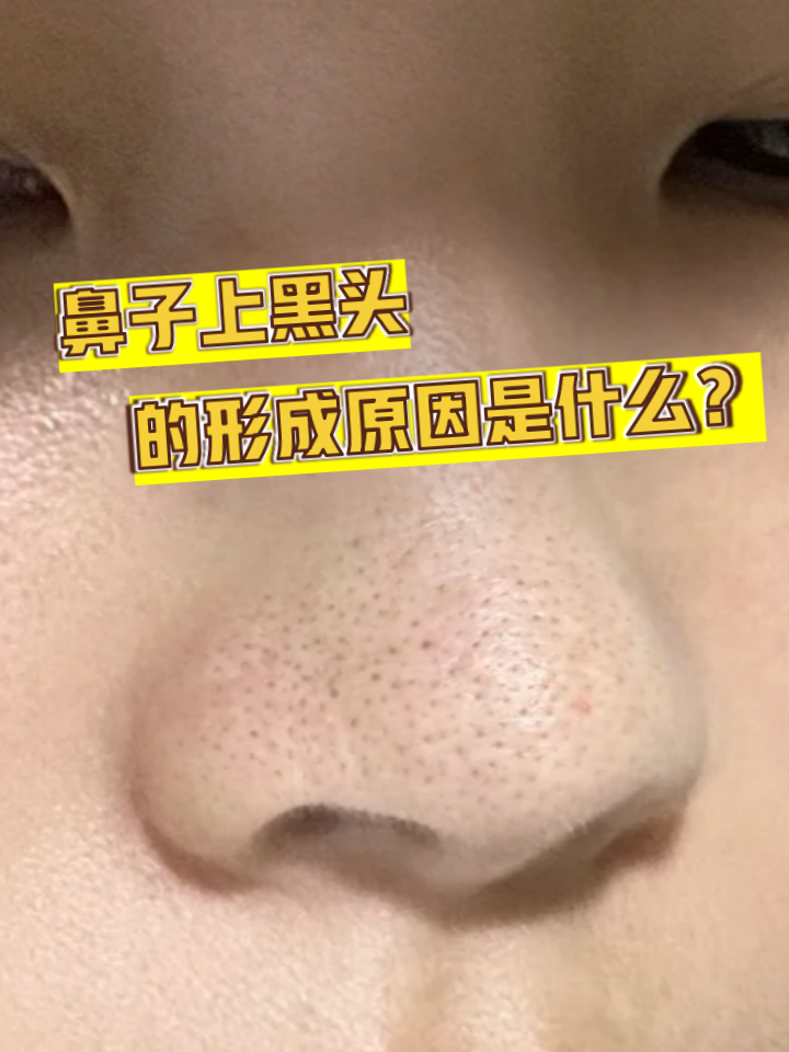 鼻子上为什么会长黑头