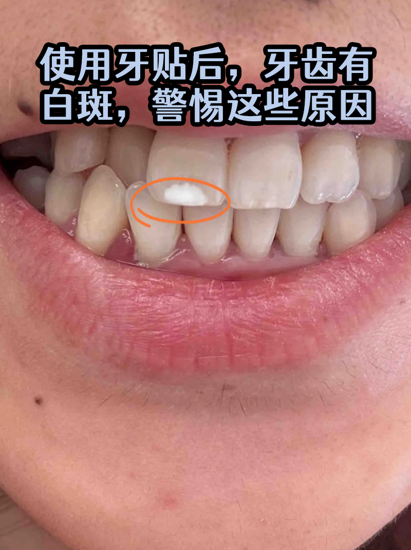 使用牙贴后,牙齿有白斑,警惕这些原因