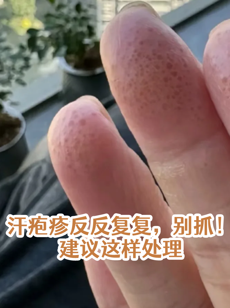 疱疹复发6次要警惕了为什么在线