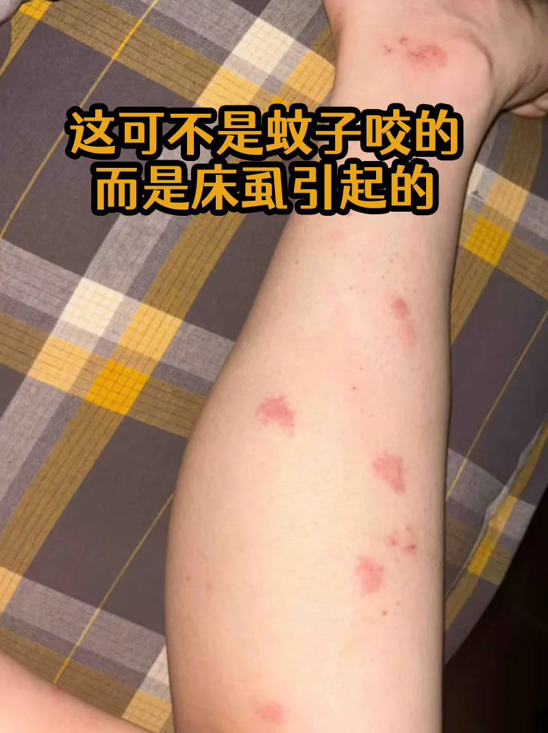 蚊子包为什么会痒