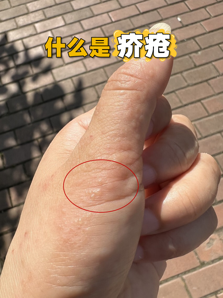 传染性:直接接触传播为主 高发部位:指缝,手腕, 疥疮的症状的照片疥疮