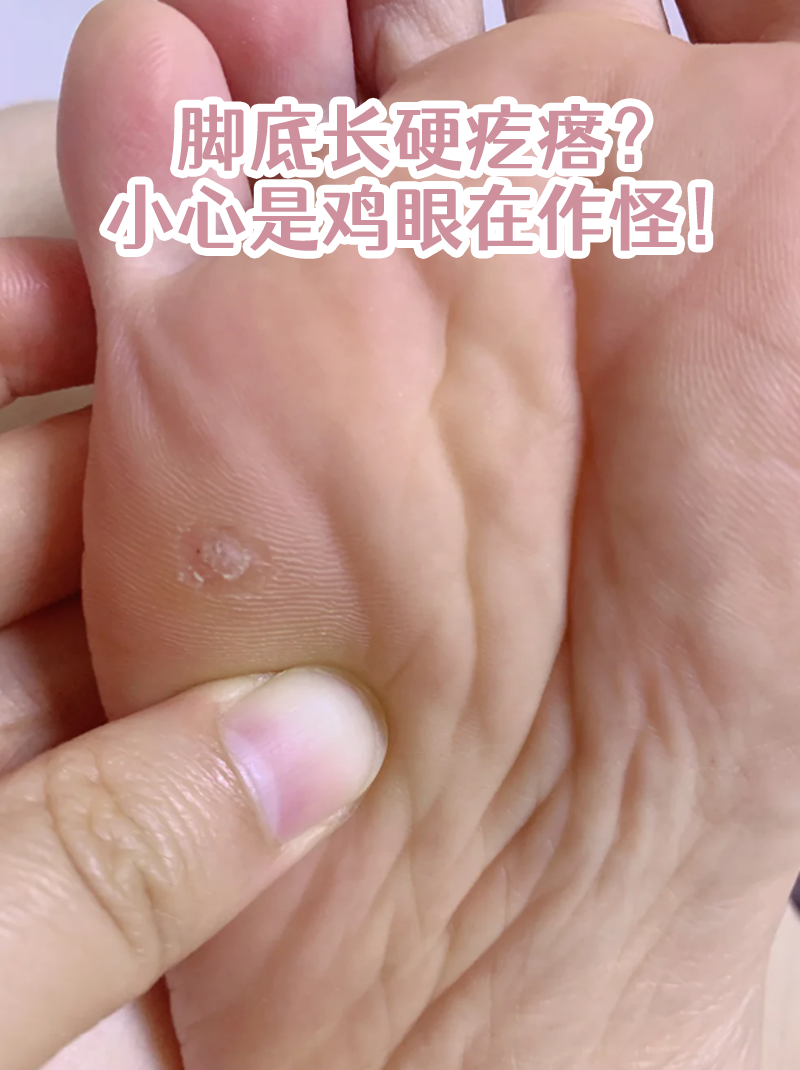 脚上长鸡眼图片脚上有凸起的硬疙瘩脚上有肉刺走路疼咋办脚底板长肉刺