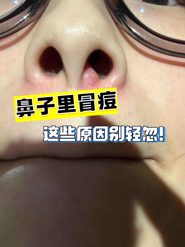 鼻腔内突然长出红肿痘痘,一碰就痛,这可不是普通青春痘!