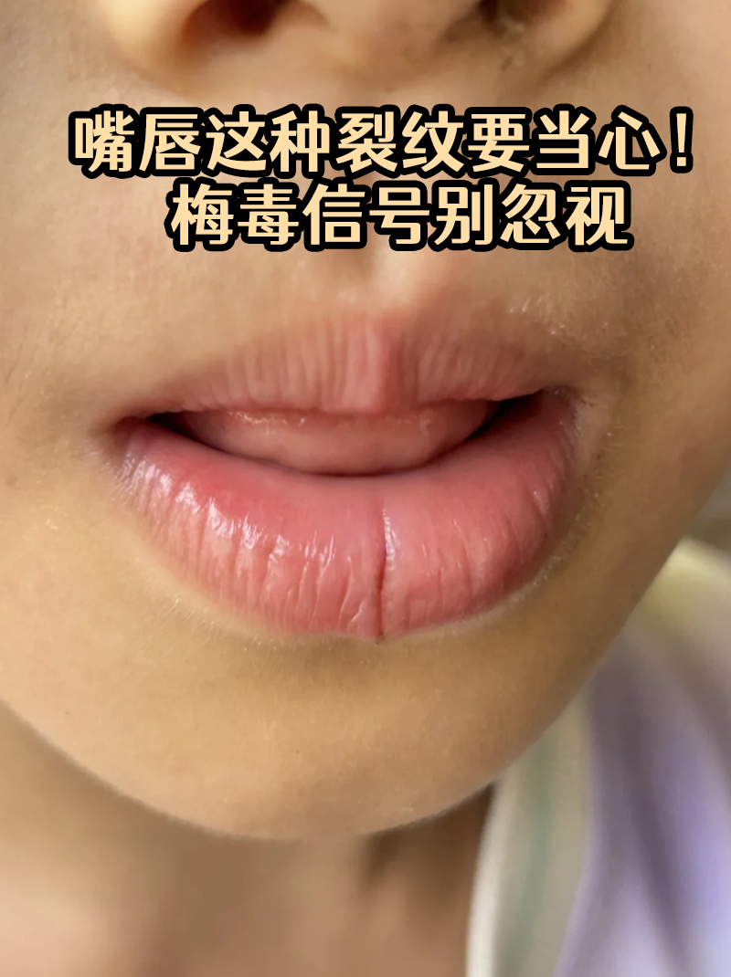 症状图片嘴唇干裂出血怎么办梅毒长在嘴巴里的照片嘴唇这种裂纹要当心