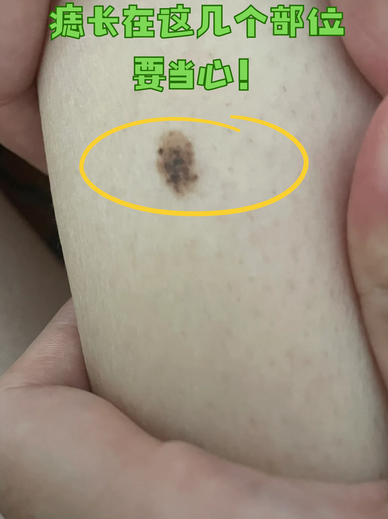 每月自检指南 工具准备: 黑色素瘤图片黑色素痣恶性黑