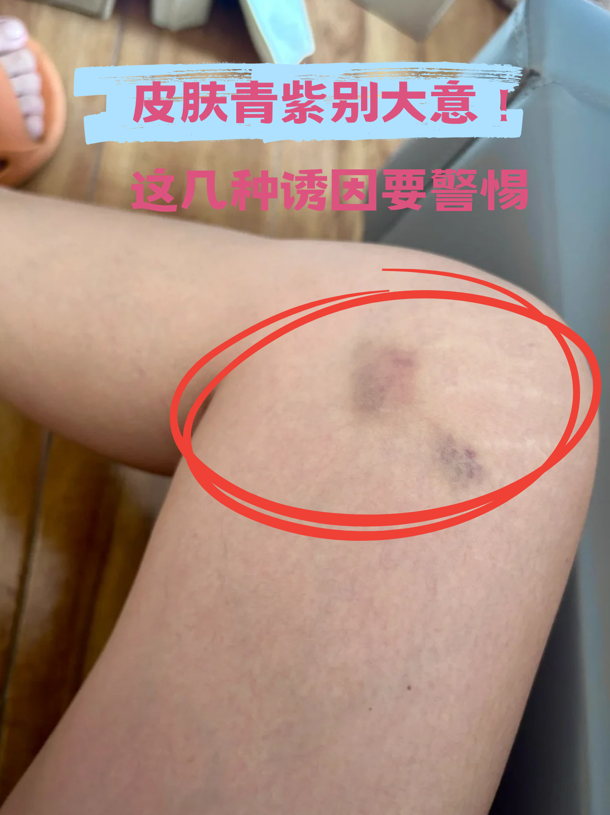 这些异常瘀斑可能是身体发出的警报!