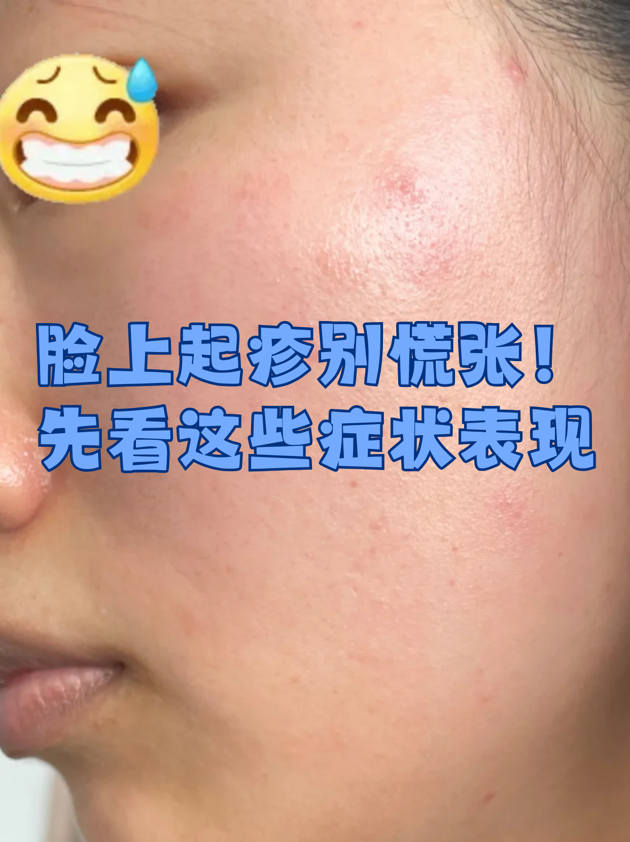 常见皮疹特征 过敏性皮疹 脂溢性皮炎 痤疮皮疹脸上湿疹的症状图片