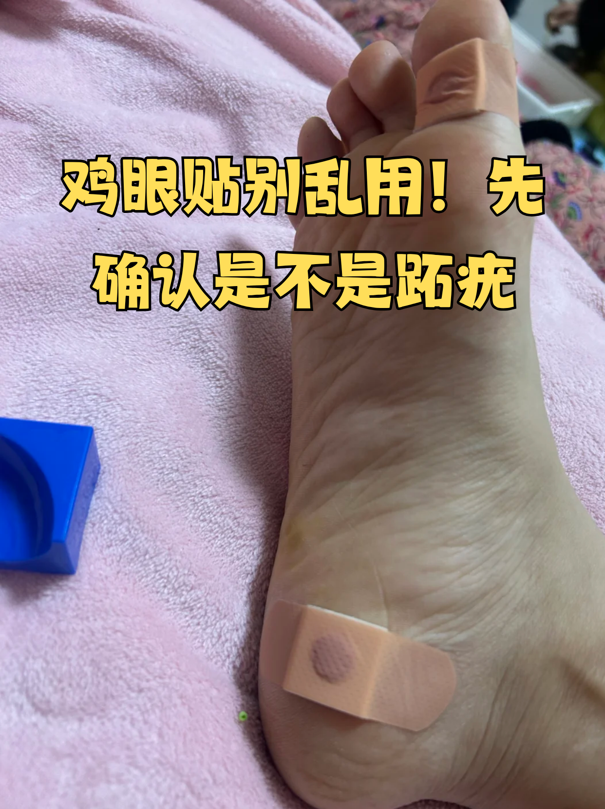 脚底长了硬疙瘩就急着贴鸡眼膏?停!